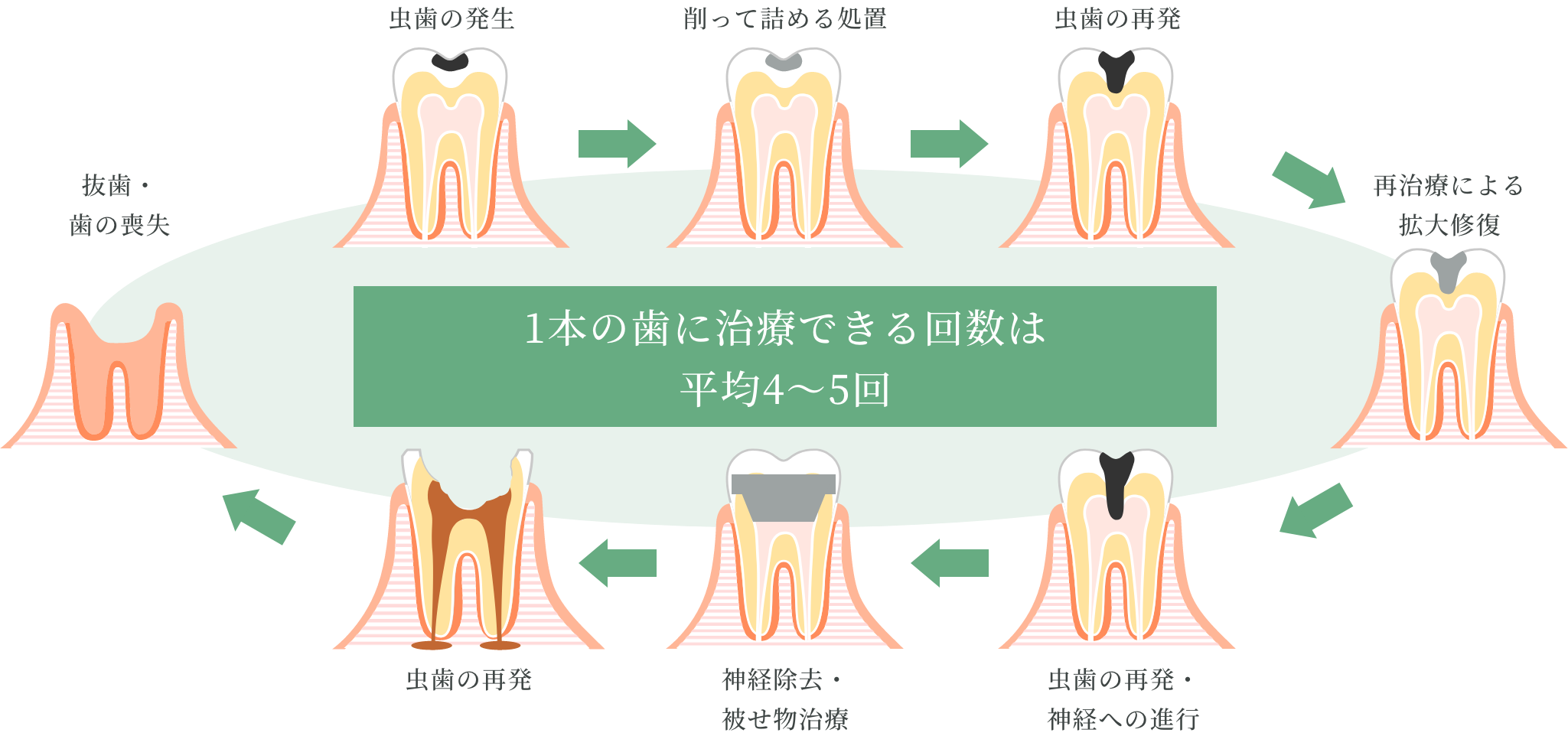 1本の歯に治療できる回数は平均4〜5回