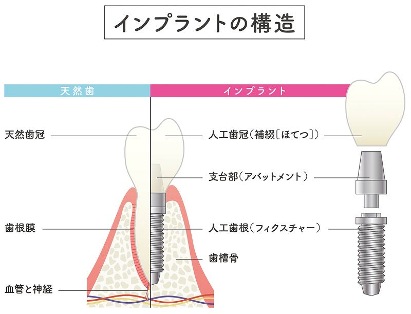天然歯とインプラントの構造比較図。天然歯の歯冠・歯根膜・血管と神経を示し、インプラント側では人工歯冠、支台部（アバットメント）、人工歯根（フィクスチャー）、歯槽骨の位置関係を説明している図。