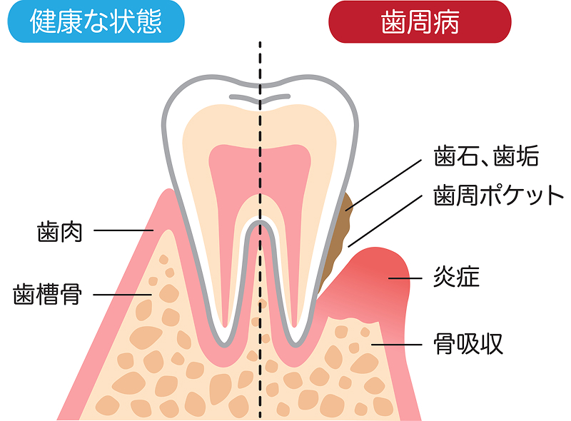 健康な歯と歯周病の比較図。左は健康な歯肉と歯槽骨、右は歯垢・歯石の付着、歯周ポケットの形成、炎症と骨吸収が進行した歯周病の状態を示している。